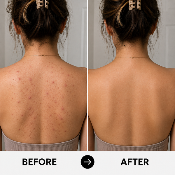 Before and after back acne results